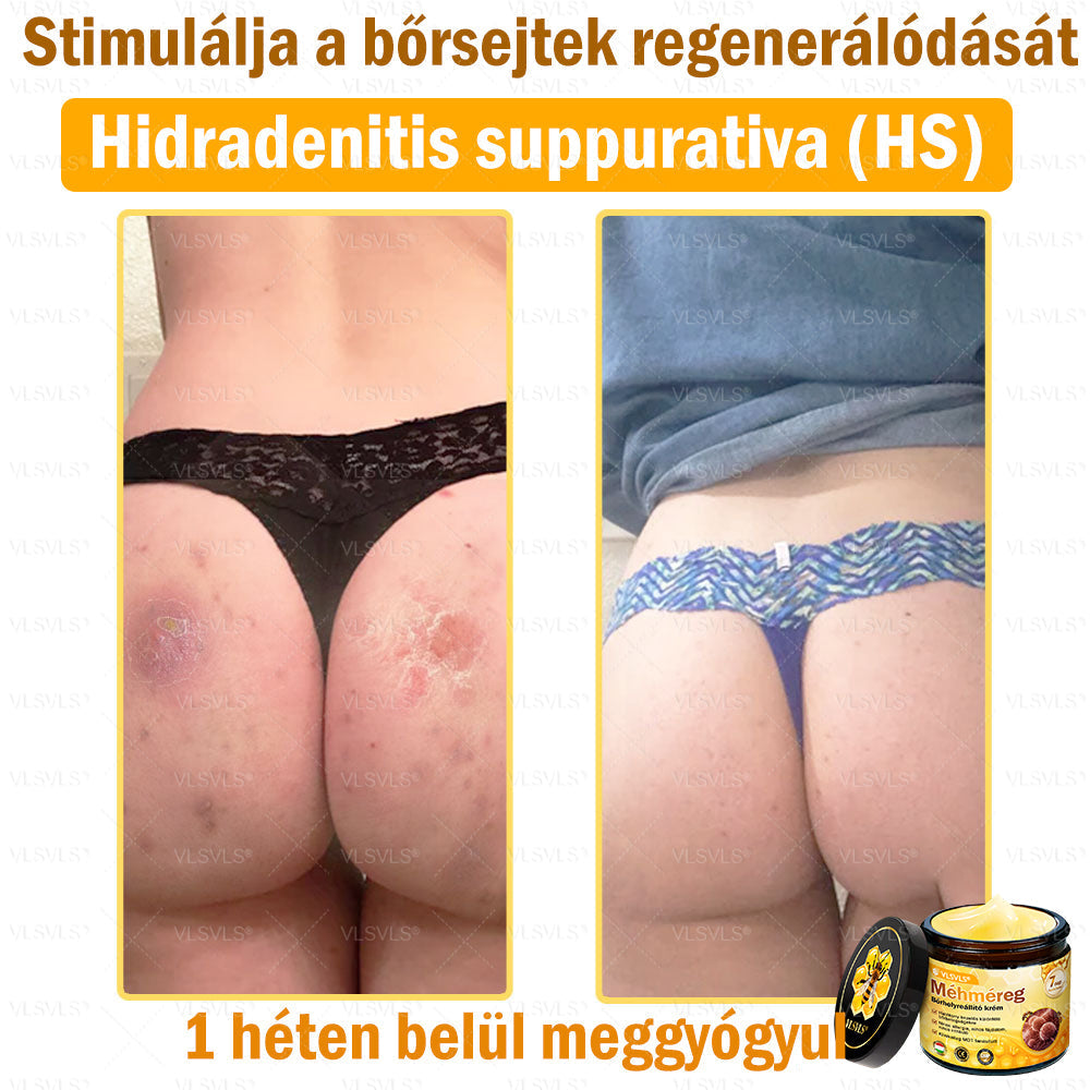✨✨💪VLSVLS® Méhméreg Bőrhelyreállító Krém (👨‍⚕‍CE jóváhagyott)👍✅