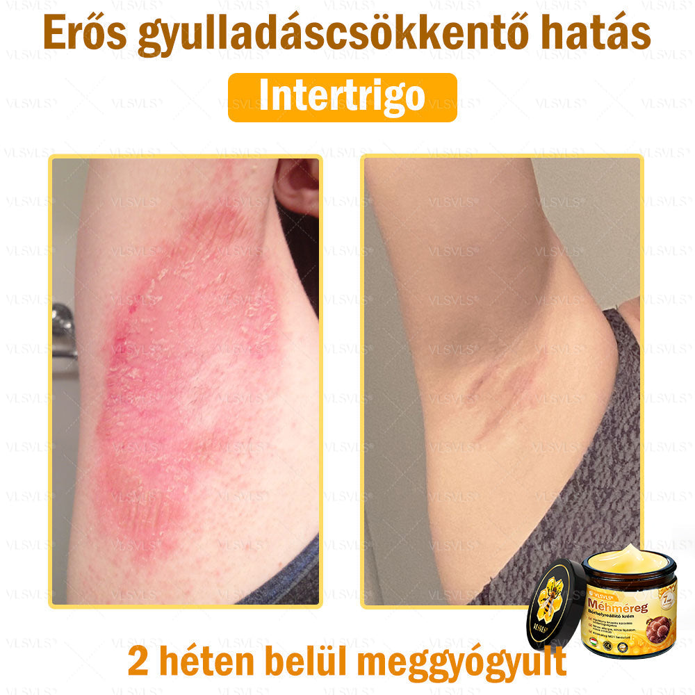 ✨✨💪VLSVLS® Méhméreg Bőrhelyreállító Krém (👨‍⚕‍CE jóváhagyott)👍✅