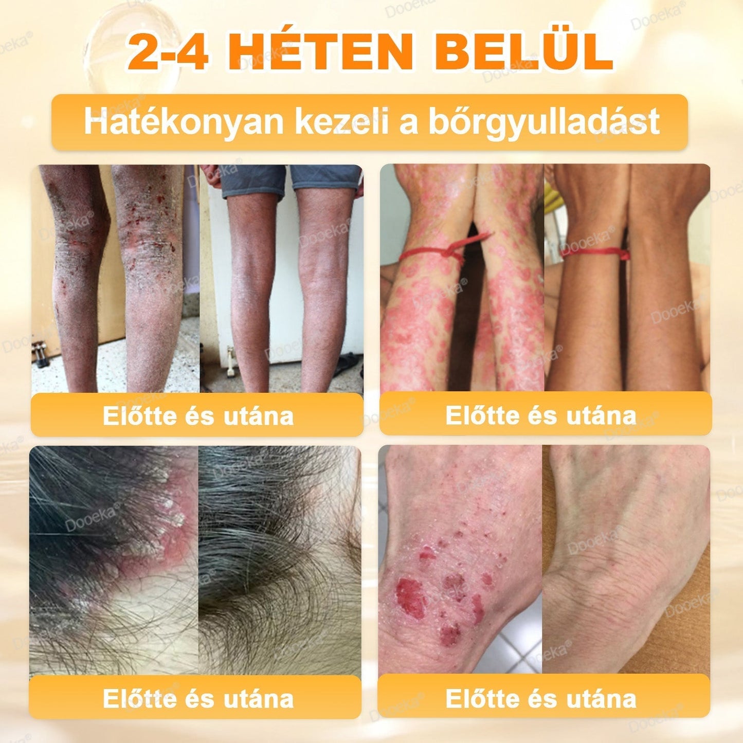 💛Dooeka® 𝟖-𝐈𝐧-𝟏 Méhméreg & Tallow Bőrfirmító és Regeneráló Krém(7 napon belül hatékony) Méhméreg + Tallow · 7X Mélyhidratálás, célozza meg a ráncokat, megereszkedést, striákat, sötét foltokat, purpurát, gyulladásokat és még sok mást.